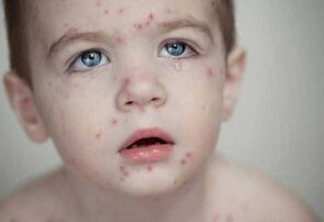 کودکان زیر ۵ سال هر چه سریع‌تر واکسن سرخک دریافت کنند