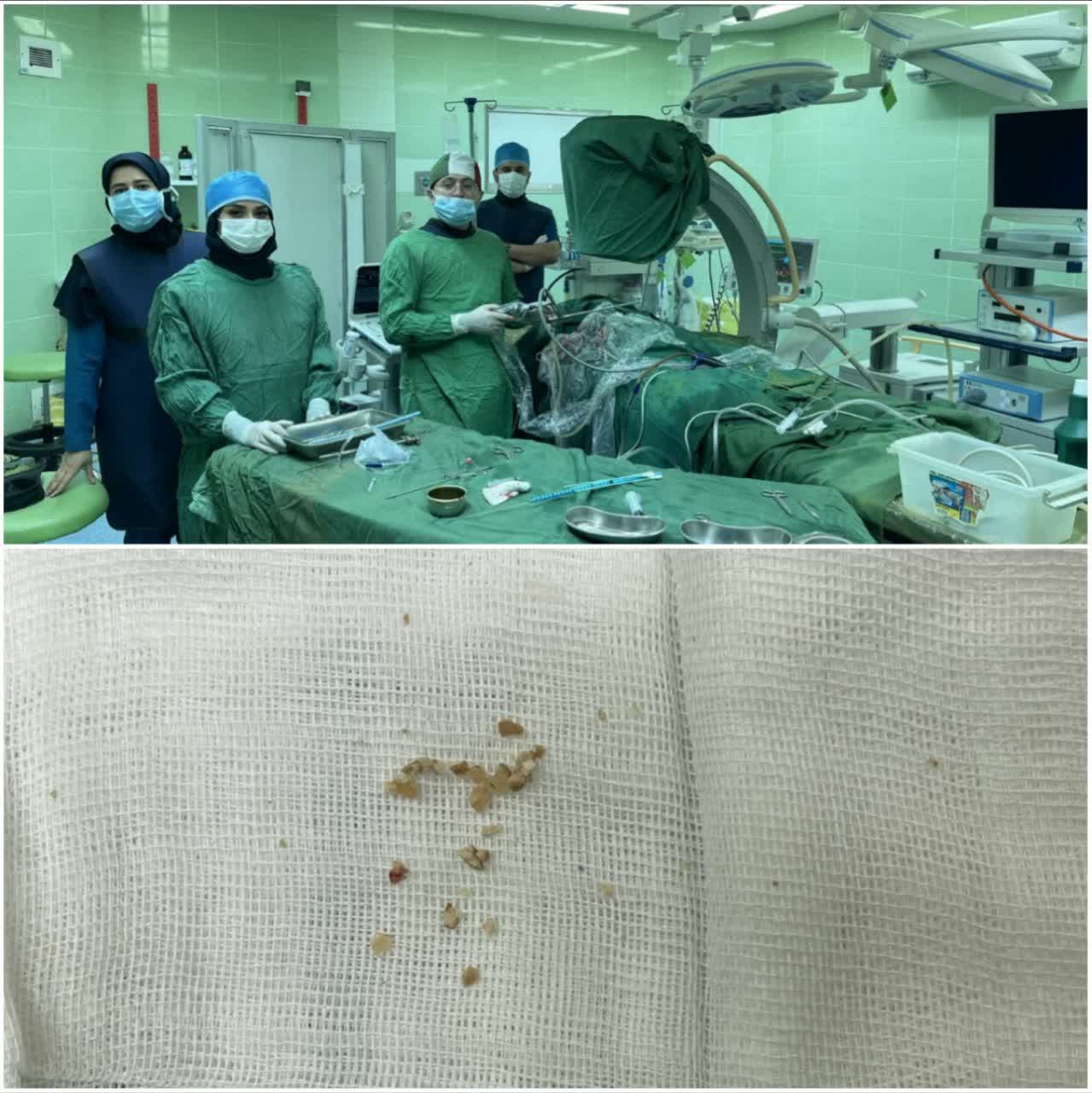  انجام عمل جراحی کلیه از طریق پوست در کودک سه ساله در بیمارستان امام رضا (ع) اردبیل